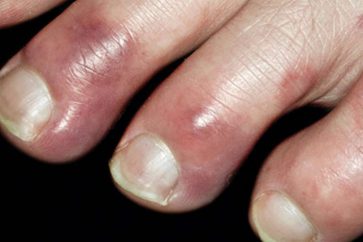 Les rougeurs sur les pieds et les mains, associés à des symptômes caractéristiques du Covid-19 comme la toux et la fièvre, « peuvent être des signes clés d’un diagnostic précoce du Covid-9 »