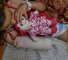 Une fillette palestinienne dont la jambe a été amputée suite aux bombardements israéliens contre Gaza.